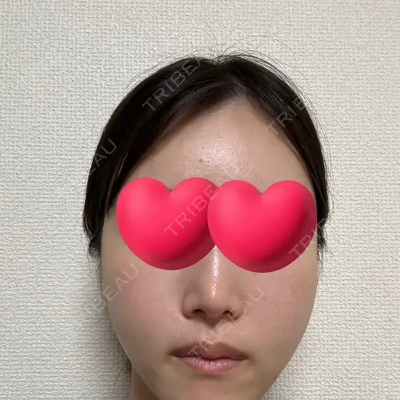 脂肪注入（輪郭） / PRP皮膚再生療法 EMMO FACE CLINIC 大宮院 DAY 5 メイン用