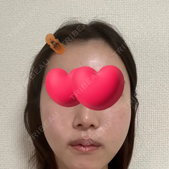 脂肪注入（輪郭） / PRP皮膚再生療法 EMMO FACE CLINIC 大宮院 DAY 6 メイン用