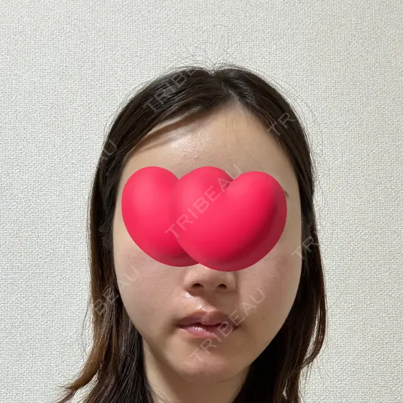 脂肪注入（輪郭） / PRP皮膚再生療法 EMMO FACE CLINIC 大宮院 DAY 8 メイン用