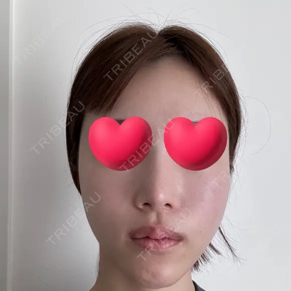 脂肪注入（輪郭） / PRP皮膚再生療法 EMMO FACE CLINIC 大宮院 AFTER メイン用