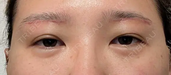 上まぶたたるみ取り / ダーマペン / 毛穴洗浄（ハイドラフェイシャルなど） Leap beauty clinic DAY 26 メイン用