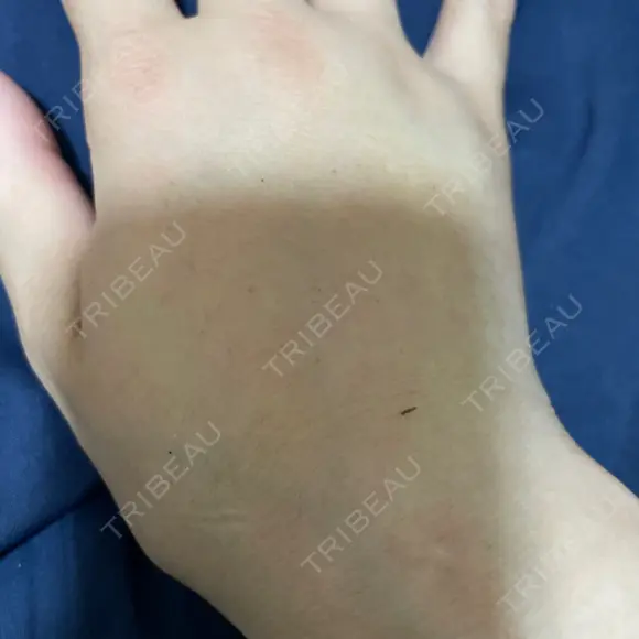 脂肪注入（肌） EMMO FACE CLINIC 大阪梅田院 DAY 10 メイン用