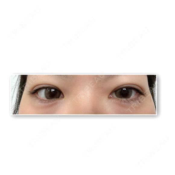 ヒアルロン酸注入（涙袋） NARU Beauty Clinic 【ナルクリ】 DAY 4 メイン用