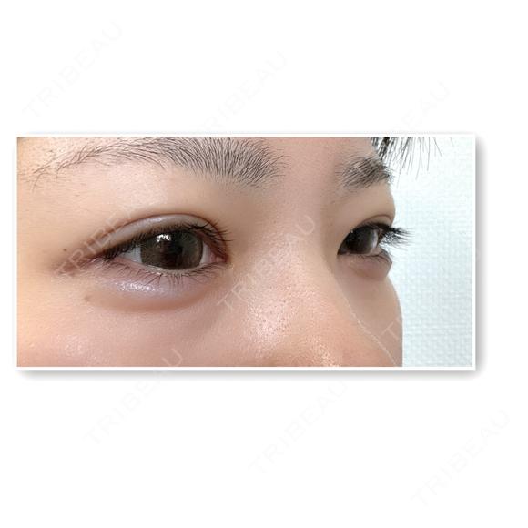 ヒアルロン酸注入（涙袋） NARU Beauty Clinic 【ナルクリ】 DAY 4 メイン用