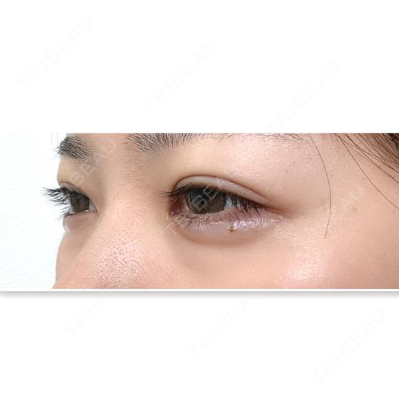 ヒアルロン酸注入（涙袋） NARU Beauty Clinic 【ナルクリ】 DAY 4 メイン用