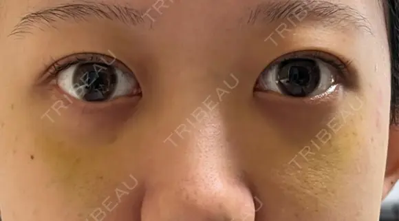 下まぶたの脂肪取り APOLLO BEAUTY CLINIC DAY 8 メイン用