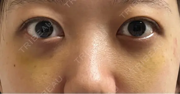 下まぶたの脂肪取り APOLLO BEAUTY CLINIC DAY 8 メイン用