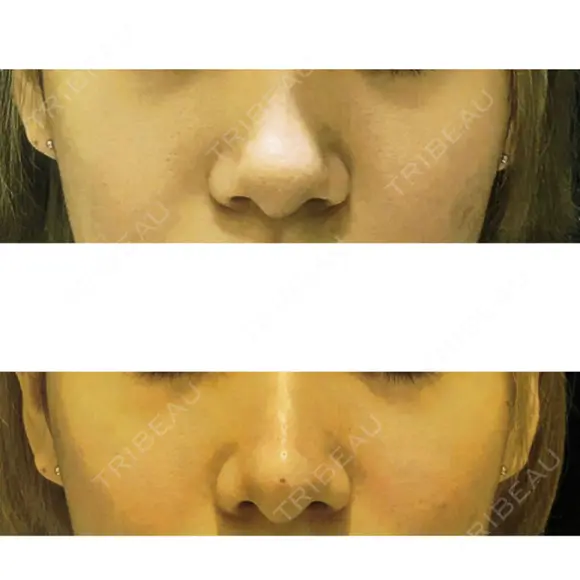 隆鼻術 / ヒアルロン酸注入（鼻） 渋谷美容外科クリニック 新宿院 AFTER メイン用