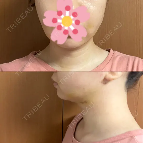 糸リフト / 脂肪吸引（顔） EMMA CLINIC（エマクリニック） DAY 10 メイン用