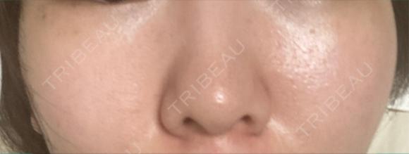 ピーリング（ニキビ・毛穴） / エレクトロポレーション / レーザートーニング（美白・肝斑） 湘南美容クリニック 川崎院 AFTER メイン用