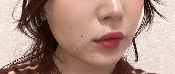 ボトックス（あご） / ヒアルロン酸注入（あご） / ボトックス（エラ・小顔） / ヒアルロン酸注入（唇） THE FIRST CLINIC 町田院 DAY 1 メイン用