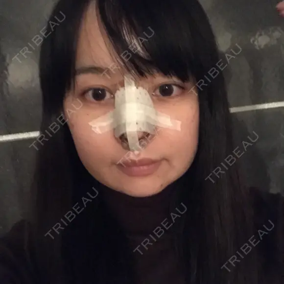 隆鼻術 / 鼻尖形成（切開） / 軟骨移植 / ワシ鼻修正・ハンプ切除 / 鼻尖縮小 表参道スキンクリニック 表参道院 DAY 7 メイン用