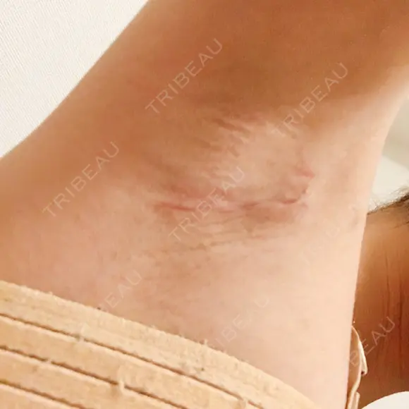 豊胸（シリコンバッグ） / 胸修正 NANA（ナナ）美容外科 DAY 13 メイン用