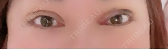 二重埋没 / 自然癒着法 東京シンデレラ美容外科 池袋院 DAY 4 メイン用