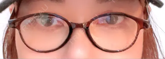 二重埋没 / 自然癒着法 東京シンデレラ美容外科 池袋院 DAY 4 メイン用