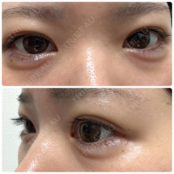 ヒアルロン酸注入（涙袋） NARU Beauty Clinic 【ナルクリ】 DAY 6 メイン用