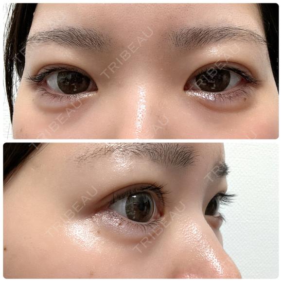 ヒアルロン酸注入（涙袋） NARU Beauty Clinic 【ナルクリ】 DAY 7 メイン用