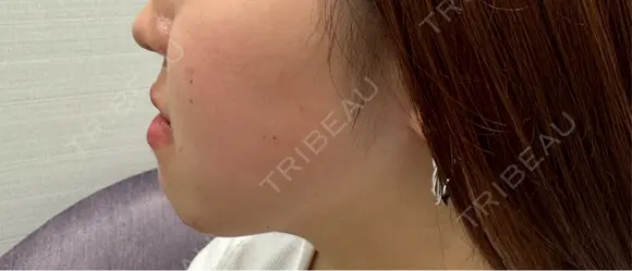 糸リフト / 脂肪吸引（顔） / ヒアルロン酸注入（あご） / ボトックス（エラ・小顔） R Beauty CLINIC 名古屋院 DAY 104 メイン用