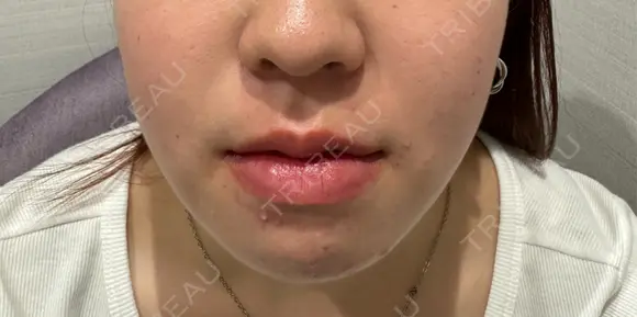 糸リフト / 脂肪吸引（顔） / ヒアルロン酸注入（あご） / ボトックス（エラ・小顔） R Beauty CLINIC 名古屋院 AFTER メイン用