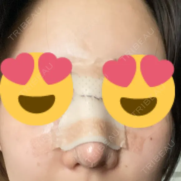 隆鼻術 / 鼻尖形成（切開） / 軟骨移植 R Beauty CLINIC 銀座院 AFTER メイン用