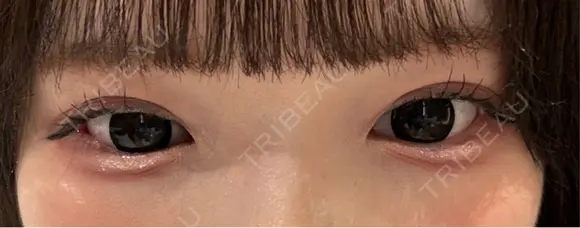 クマ治療 / 目尻切開 / タレ目形成・グラマラスライン（切開） R Beauty CLINIC 銀座院 AFTER メイン用