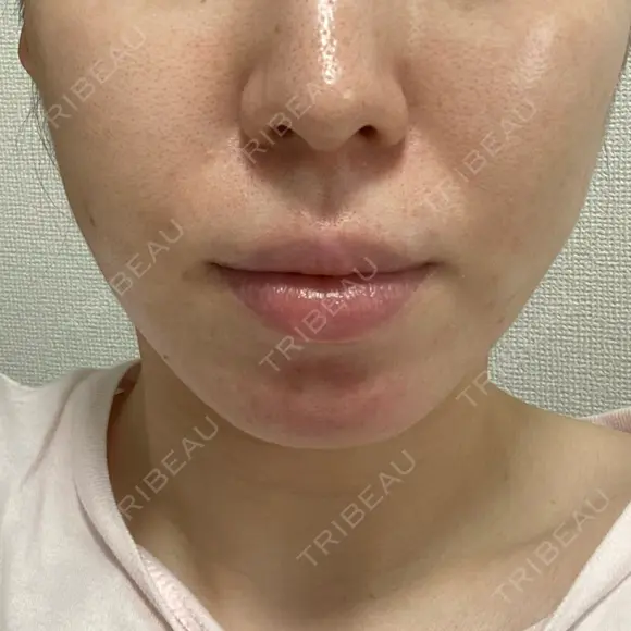 糸リフト / 脂肪吸引（顔） EMMA CLINIC（エマクリニック） DAY 14 メイン用