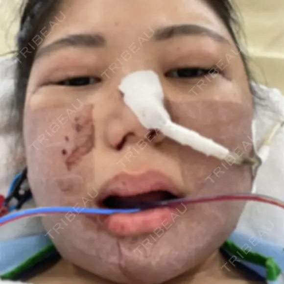 骨切り（あご） / 骨削り（エラ） / 骨削り（頬） / ルフォー+ssro（両あご) / 輪郭修正 / その他 リラ・クラニオフェイシャル・クリニック DAY 1 メイン用