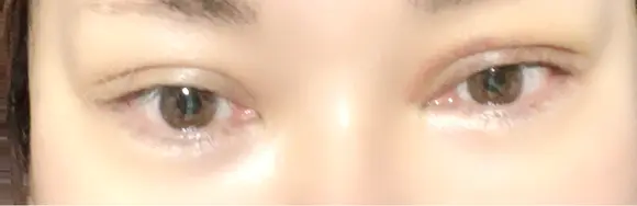 二重埋没 / 自然癒着法 東京シンデレラ美容外科 池袋院 DAY 8 メイン用