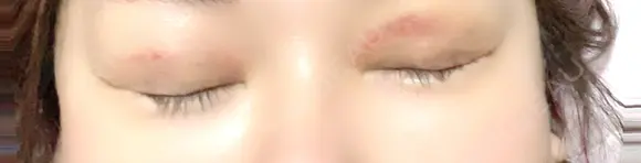 二重埋没 / 自然癒着法 東京シンデレラ美容外科 池袋院 DAY 8 メイン用