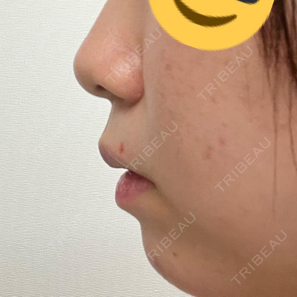 ヒアルロン酸注入（あご） プリモ麻布十番クリニック AFTER メイン用