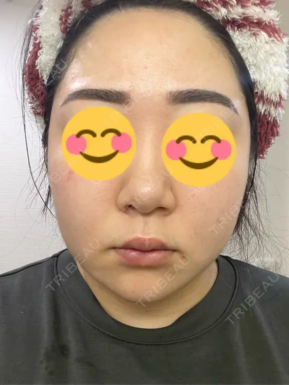 ピコレーザートーニング（美白・肝斑） / ピコフラクショナルレーザー（毛穴・ニキビ跡） おおかみ美容のクリニック 新宿院 AFTER メイン用