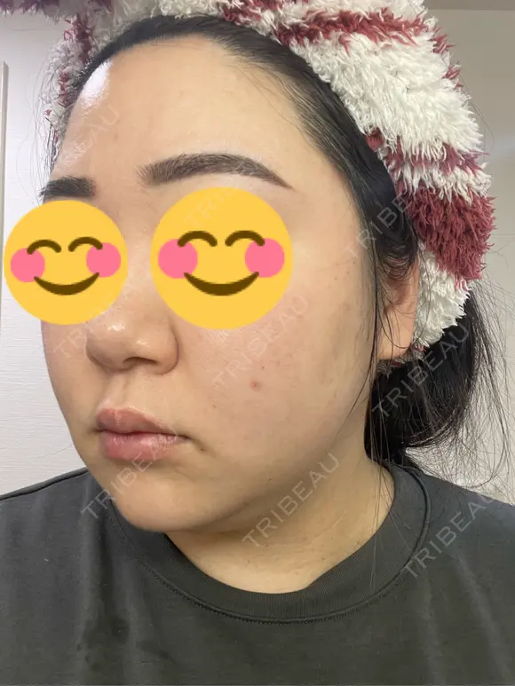 ピコレーザートーニング（美白・肝斑） / ピコフラクショナルレーザー（毛穴・ニキビ跡） おおかみ美容のクリニック 新宿院 DAY 14 メイン用