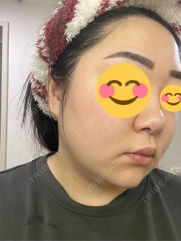 ピコレーザートーニング（美白・肝斑） / ピコフラクショナルレーザー（毛穴・ニキビ跡） おおかみ美容のクリニック 新宿院 DAY 14 メイン用