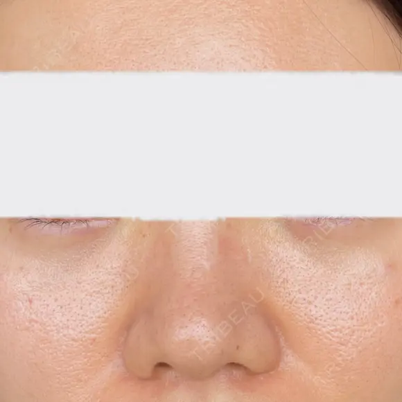 クマ治療 / ヒアルロン酸注入（目の下） ROOTS Clinic DAY 0 メイン用