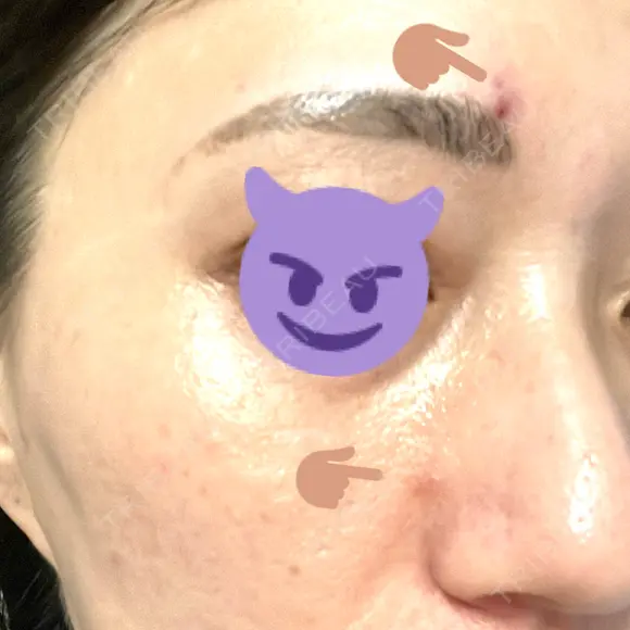 ポテンツァ 渋谷美容外科クリニック 横浜院 DAY 1 メイン用