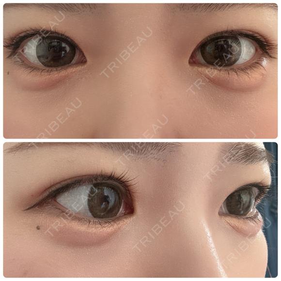 ヒアルロン酸注入（涙袋） NARU Beauty Clinic 【ナルクリ】 DAY 10 メイン用