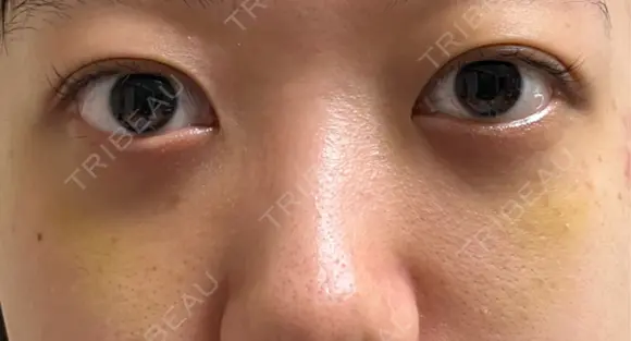 下まぶたの脂肪取り APOLLO BEAUTY CLINIC DAY 11 メイン用