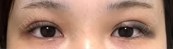 二重埋没 水の森美容クリニック 大阪梅田院 DAY 0 メイン用