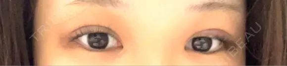 二重埋没 水の森美容クリニック 大阪梅田院 DAY 1 メイン用