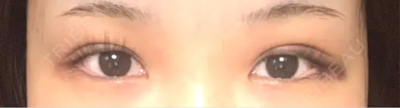 二重埋没 水の森美容クリニック 大阪梅田院 DAY 2 メイン用