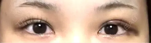 二重埋没 水の森美容クリニック 大阪梅田院 DAY 4 メイン用