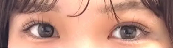 二重埋没 水の森美容クリニック 大阪梅田院 DAY 5 メイン用