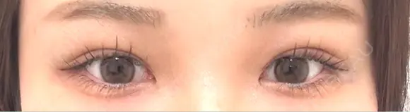 二重埋没 水の森美容クリニック 大阪梅田院 DAY 7 メイン用