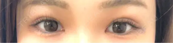 二重埋没 水の森美容クリニック 大阪梅田院 DAY 8 メイン用