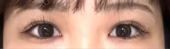 二重埋没 水の森美容クリニック 大阪梅田院 AFTER メイン用