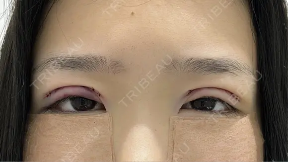二重切開 / クマ治療 R Beauty CLINIC 銀座院 AFTER メイン用