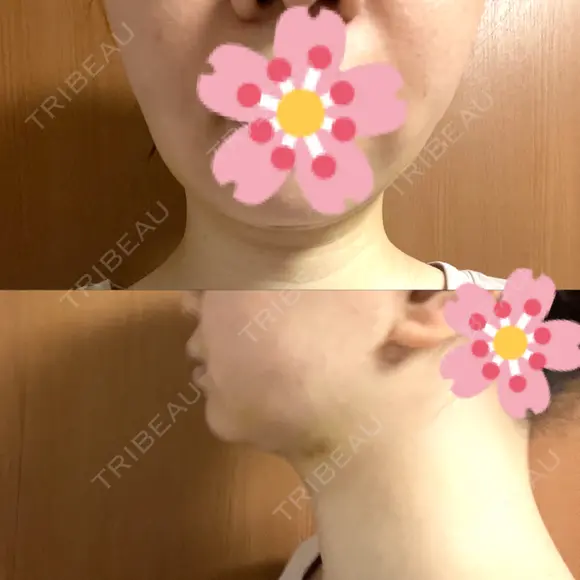 糸リフト / 脂肪吸引（顔） EMMA CLINIC（エマクリニック） DAY 14 メイン用