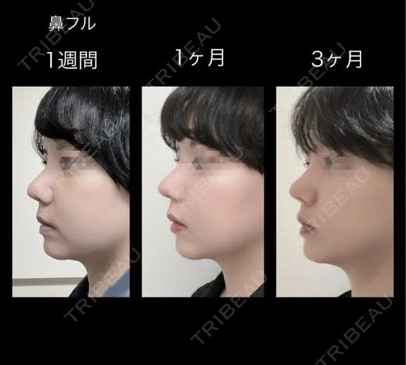 隆鼻術 / 鼻尖形成（切開） / 鼻中隔延長（切開） / 骨切幅寄せ / ワシ鼻修正・ハンプ切除 LUHO（ルホ）美容外科 DAY 90 メイン用