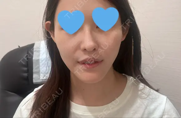 クマ治療 WOM CLINIC GINZA （ワム クリニック ギンザ） AFTER メイン用