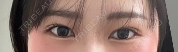 その他（目元） / 自然癒着法 LUHO（ルホ）美容外科 DAY 30 メイン用